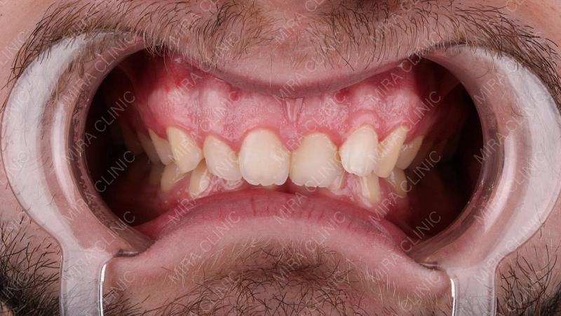 Dental Care in France vs Turkey: